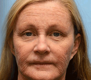 Zostalo už len 5 plechoviek! Ponúkame 50 % extra zľavu! Udržujte svoju pleť zdravú. Ak to teraz zmeškáte, budete mať šancu až budúci rok!